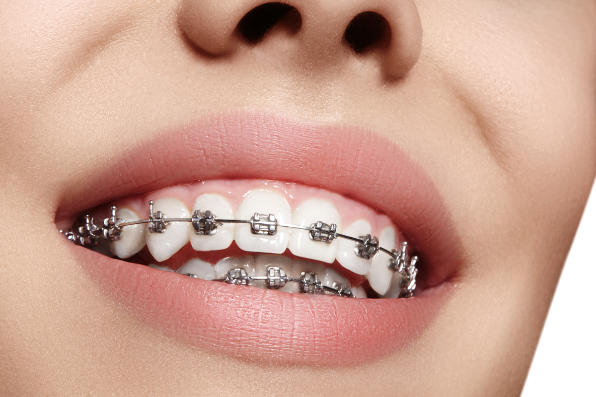 Slider 2 Gençlerde Ortodonti Adana - Dr. Dt. Cemal Şişman
