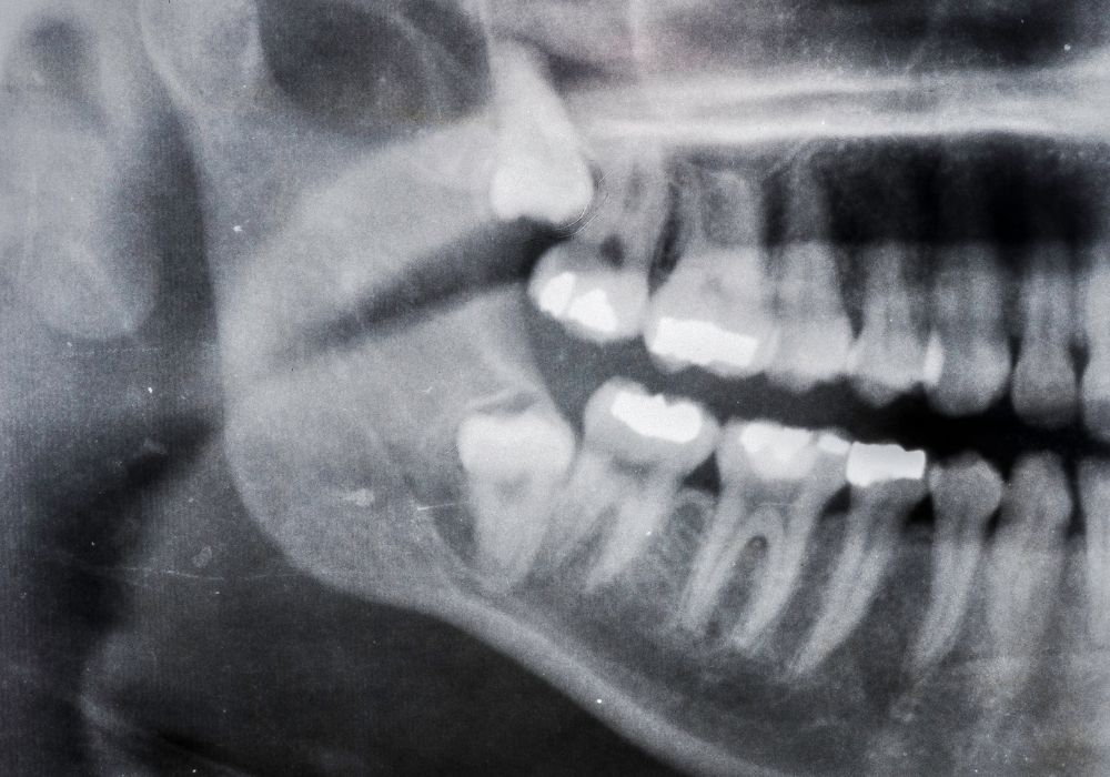 Gömülü Dişlerin Hepsi Çekilmeli Mi?