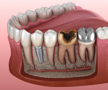 Cerrahi(İmplant, gömülü dişler...)  Tedaviler